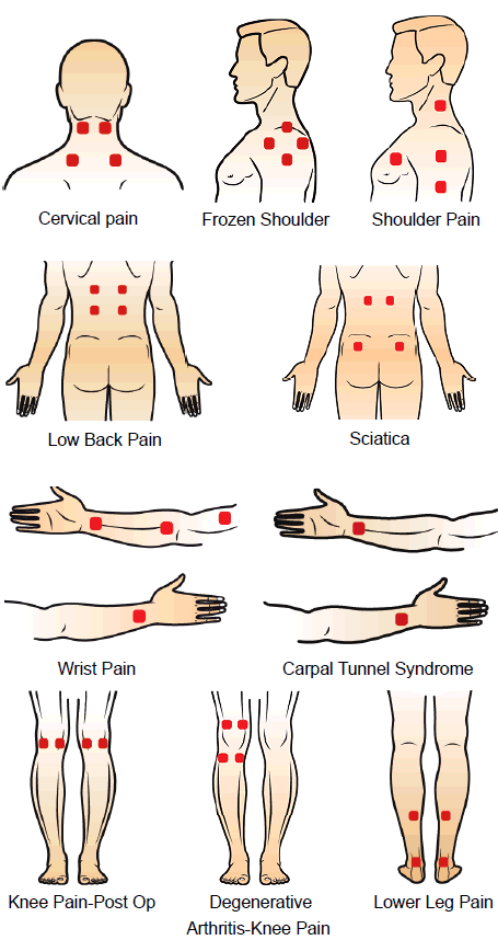 TENS-Treatment-Placement.gif